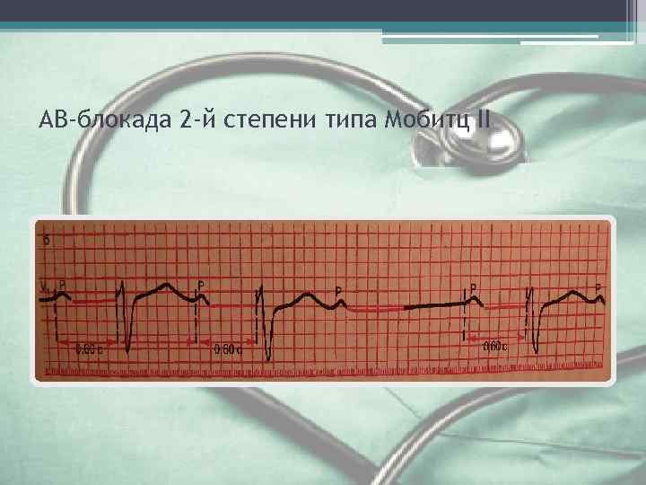 АВ-блокада 2 -й степени типа Мобитц II 