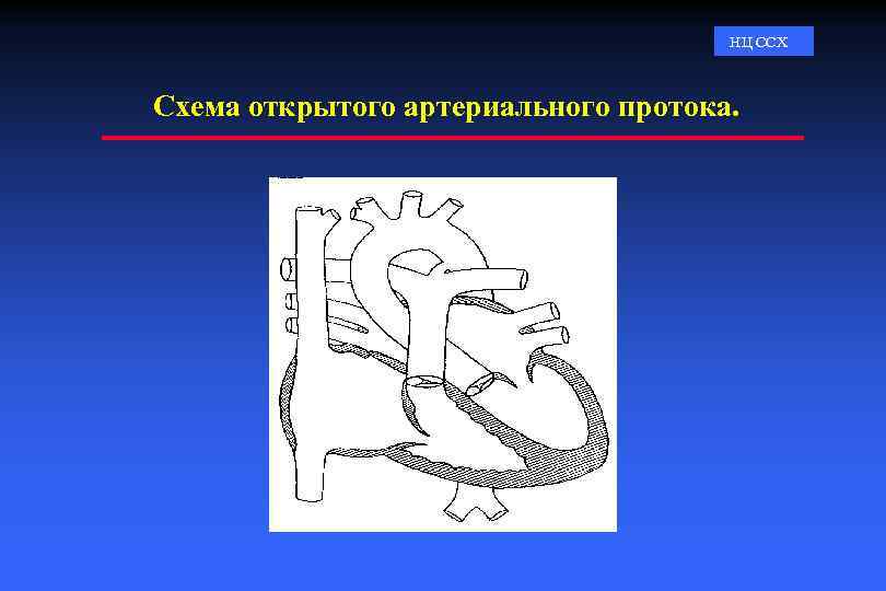 НЦ ССХ Схема открытого артериального протока. 