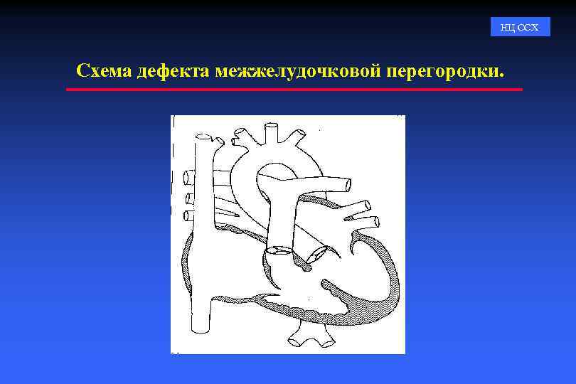 НЦ ССХ Схема дефекта межжелудочковой перегородки. 