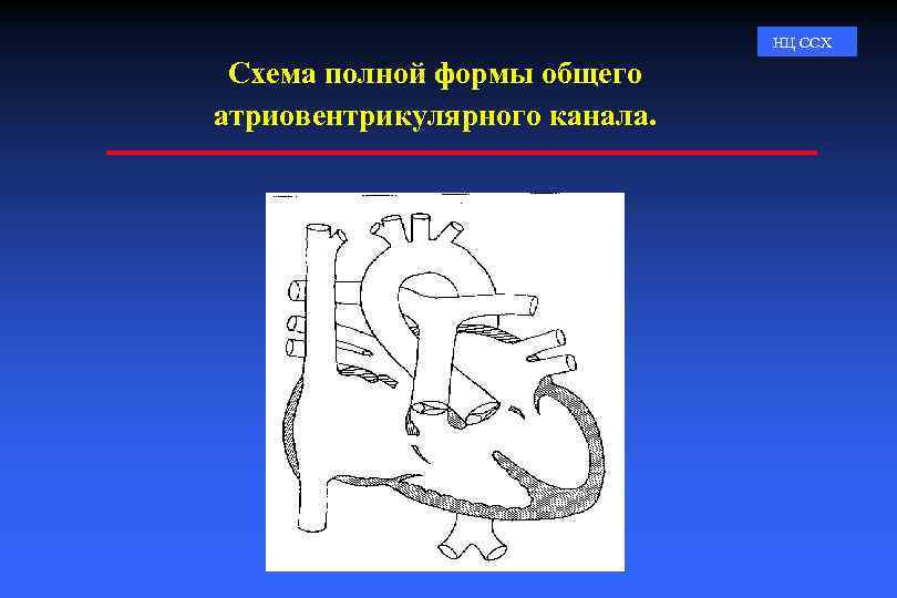НЦ ССХ Схема полной формы общего атриовентрикулярного канала. 