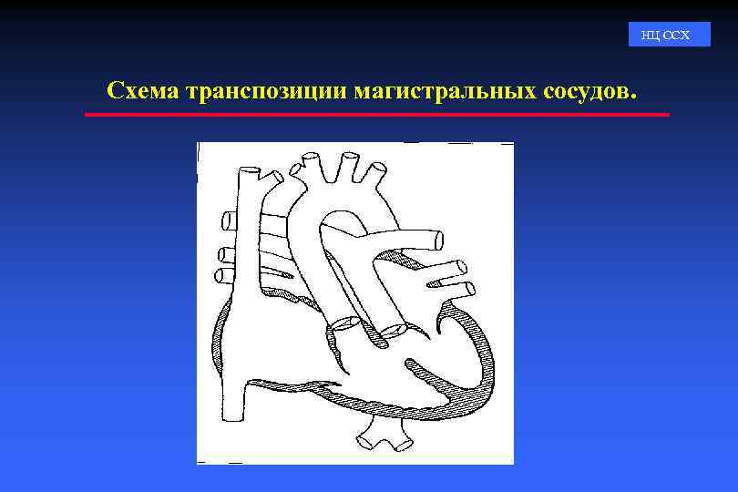 Магистральные сосуды это. Схема магистральных сосудов. Транспозиция магистральных сосудов ЭКГ. Схема транспозиции. Классификация транспозиции магистральных артерий.