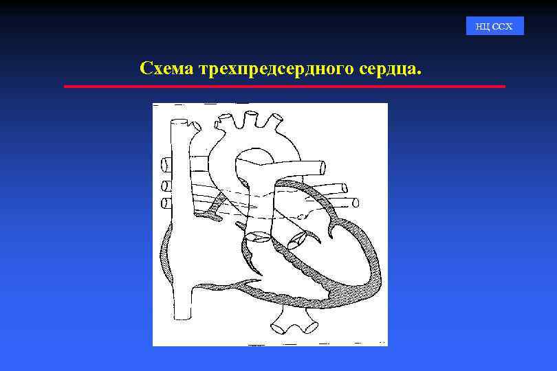 НЦ ССХ Схема трехпредсердного сердца. 