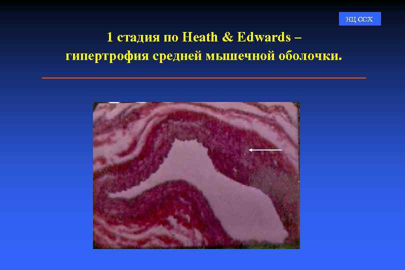 НЦ ССХ 1 стадия по Heath & Edwards – гипертрофия средней мышечной оболочки. 