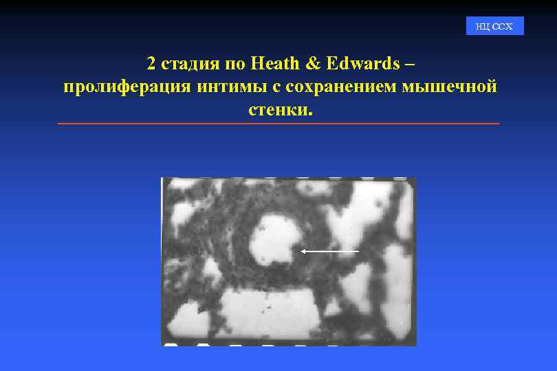 НЦ ССХ 2 стадия по Heath & Edwards – пролиферация интимы с сохранением мышечной