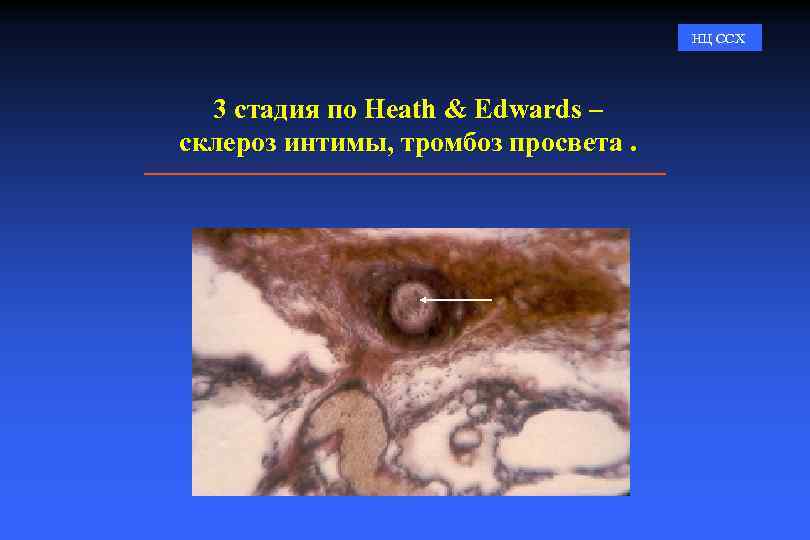 НЦ ССХ 3 стадия по Heath & Edwards – склероз интимы, тромбоз просвета. 