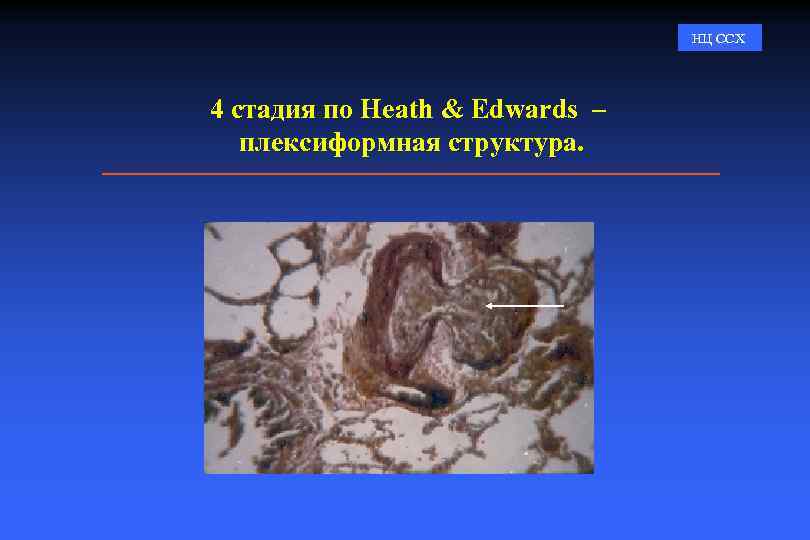 НЦ ССХ 4 стадия по Heath & Edwards – плексиформная структура. 