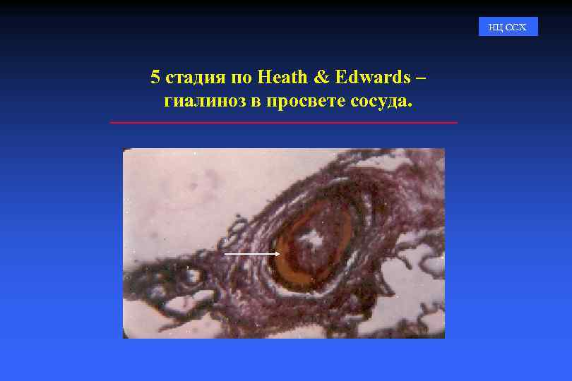НЦ ССХ 5 стадия по Heath & Edwards – гиалиноз в просвете сосуда. 