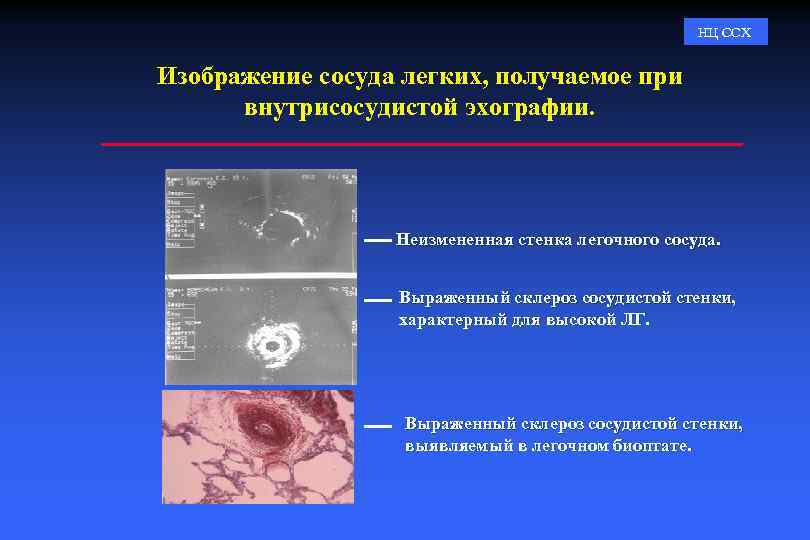 НЦ ССХ Изображение сосуда легких, получаемое при внутрисосудистой эхографии. Неизмененная стенка легочного сосуда. Выраженный