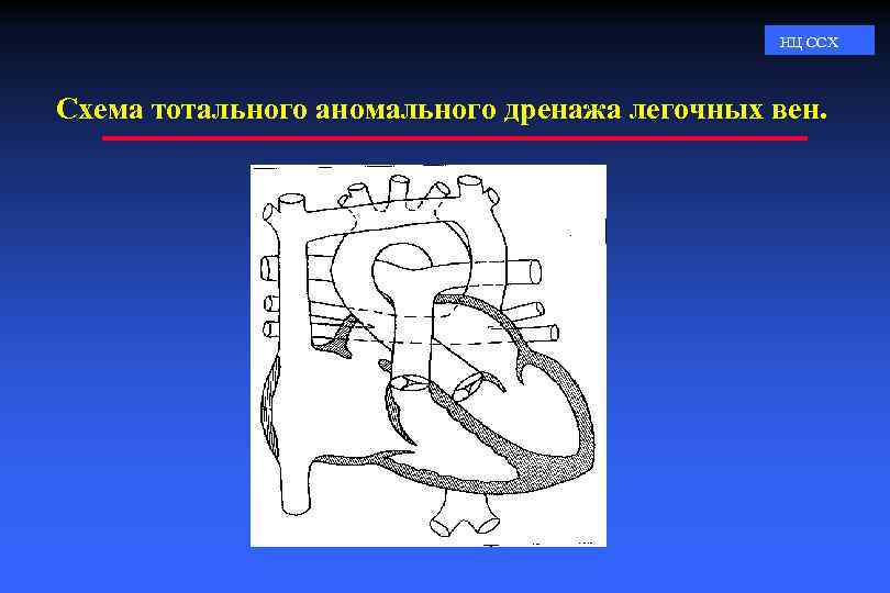 НЦ ССХ Схема тотального аномального дренажа легочных вен. 