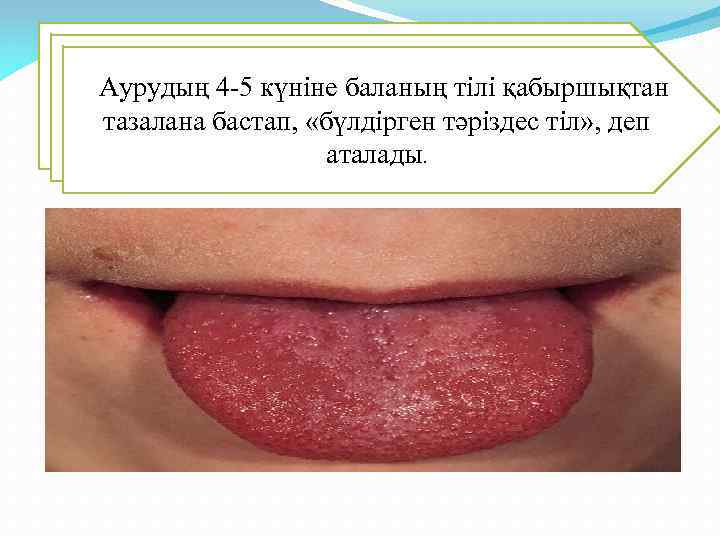  Аурудың 4 -5 күніне баланың тілі қабыршықтан тазалана бастап, «бүлдірген тәріздес тіл» ,