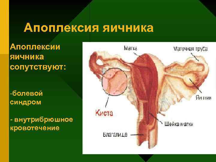 Апоплексия яичника Апоплексии яичника сопутствуют: -болевой синдром - внутрибрюшное кровотечение 