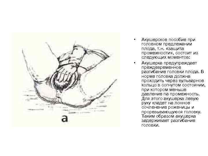  • • Акушерское пособие при головном предлежании плода, т. н. «защита промежности» ,