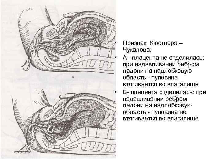 Признаки отделения плаценты. Признак отделения последа Кюстнера-Чукалова. Признак отделения плаценты Кюстнера-Чукалова. Метод Чукалова Кюстнера.