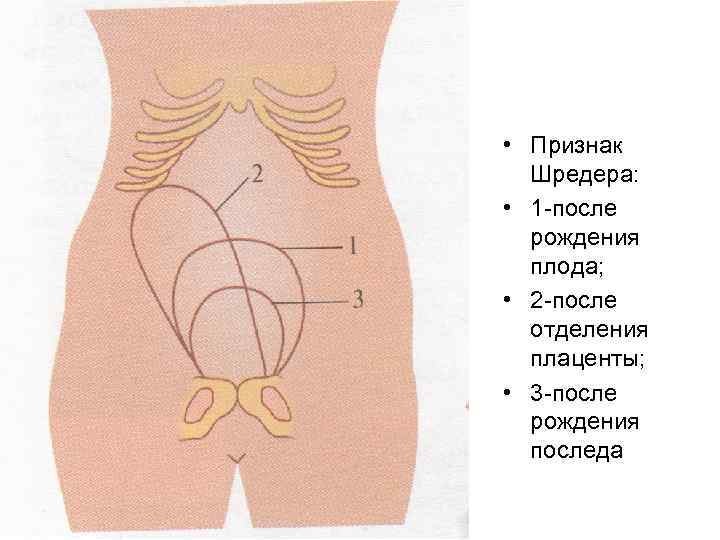  • Признак Шредера: • 1 -после рождения плода; • 2 -после отделения плаценты;