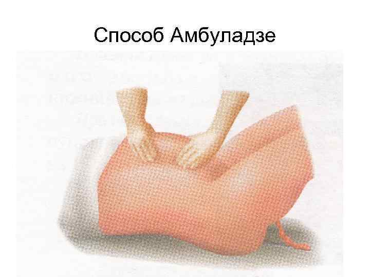 Способ Амбуладзе 