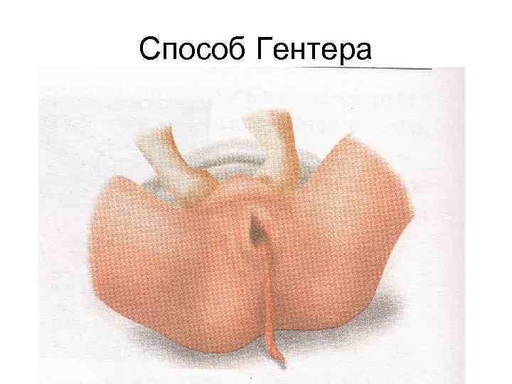 Способ Гентера 