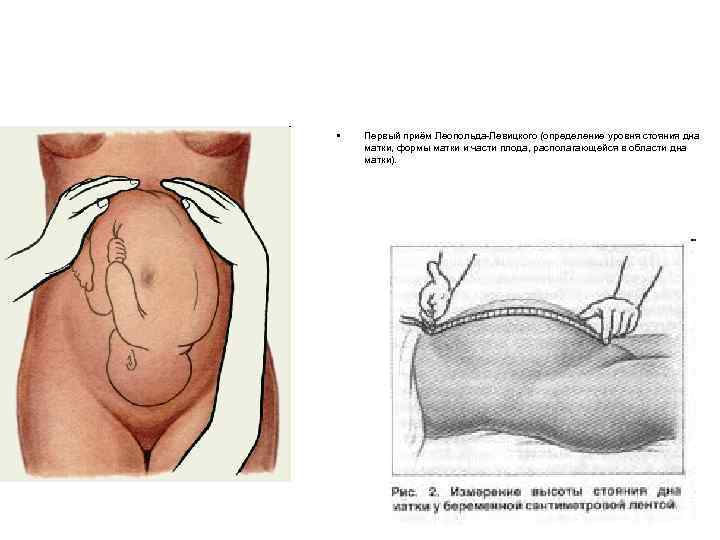  • Первый приём Леопольда-Левицкого (определение уровня стояния дна матки, формы матки и части