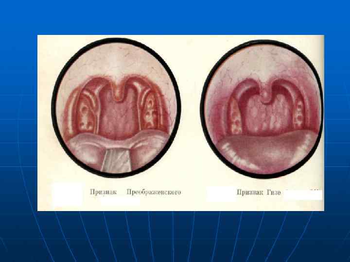 Обостренный хронический тонзиллит фото