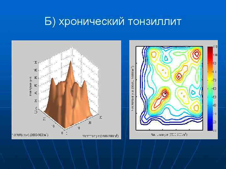 Б) хронический тонзиллит 