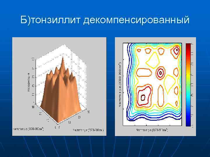 Б)тонзиллит декомпенсированный 