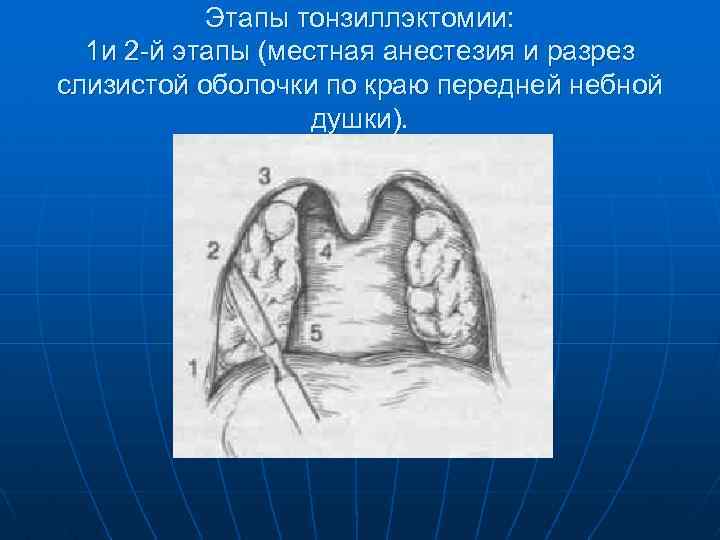 Этапы тонзиллэктомии: 1 и 2 -й этапы (местная анестезия и разрез слизистой оболочки по