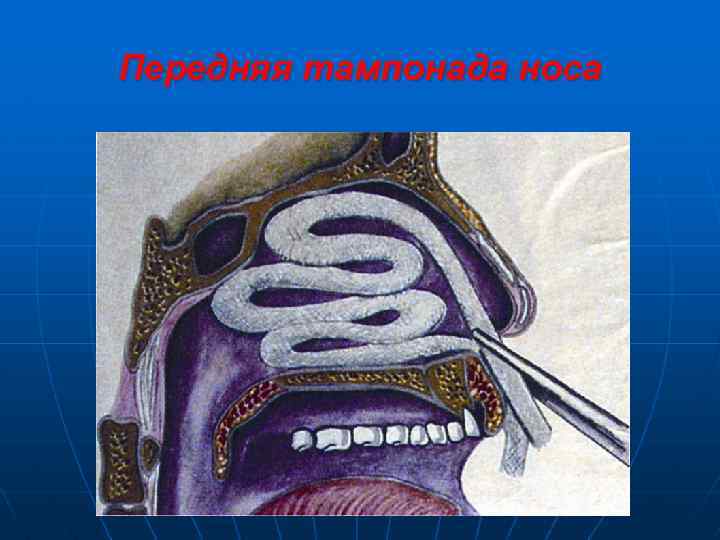 Передняя тампонада носа 
