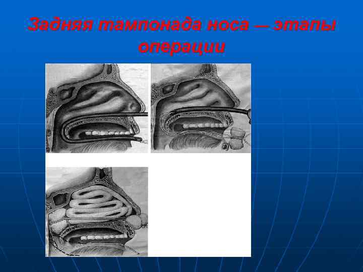 Задняя тампонада носа — этапы операции 