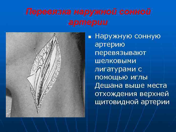 Перевязка наружной сонной артерии n Наружную сонную артерию перевязывают шелковыми лигатурами с помощью иглы