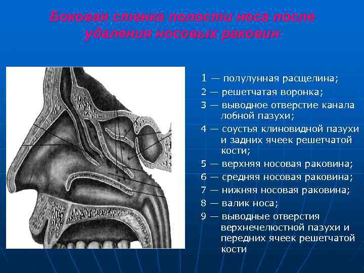 Боковая стенка полости носа после удаления носовых раковин 1 — полулунная расщелина; 2 —
