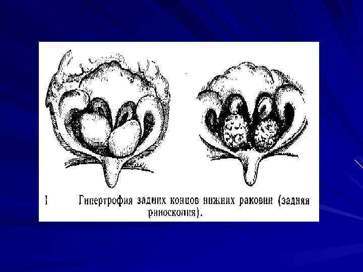 Морфологическая дезинтеграция растения. Гипертрофический ринит кт. Гипертрофия носовых раковин.