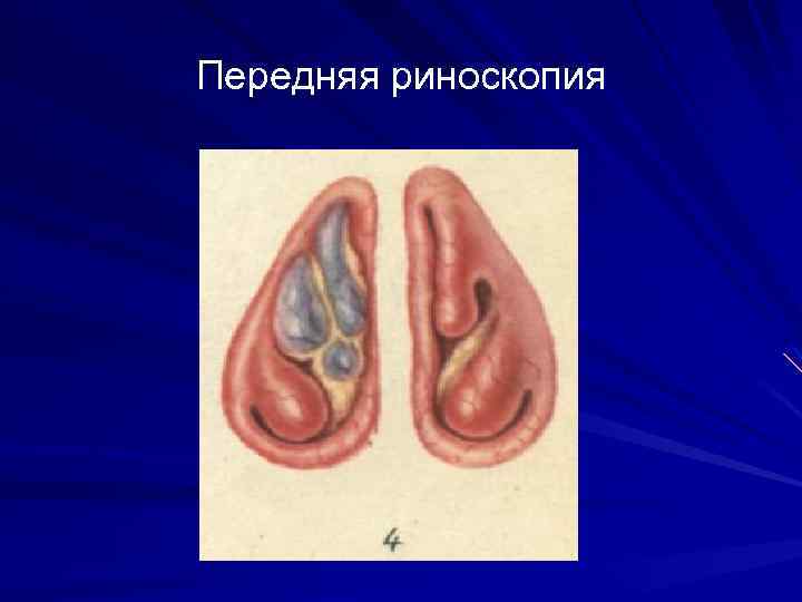 Риноскопическая картина при аллергическом рините