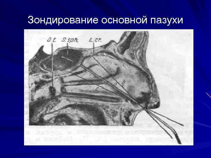 Основная пазуха. Зондирование основной пазухи. Зондирование носовых пазух. Зондирование клиновидной пазухи. Зондирования около носовых ппщух.