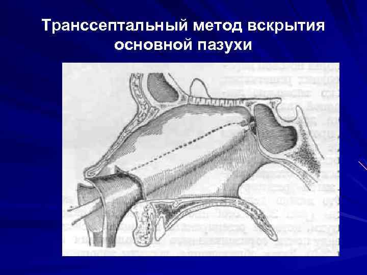 Транссептальный метод вскрытия основной пазухи 