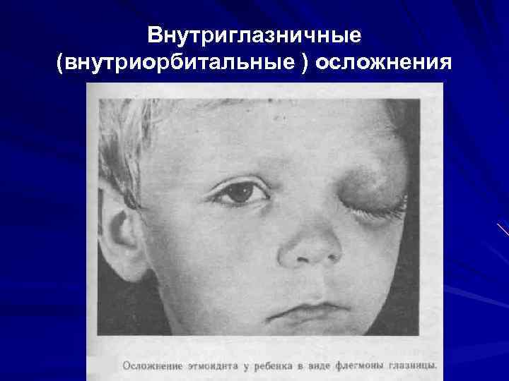 Внутриглазничные (внутриорбитальные ) осложнения 