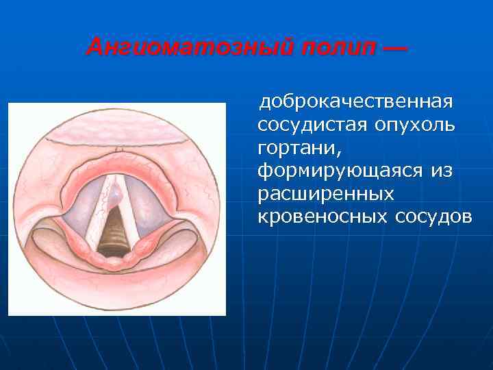 Ангиоматозный полип — доброкачественная сосудистая опухоль гортани, формирующаяся из расширенных кровеносных сосудов 