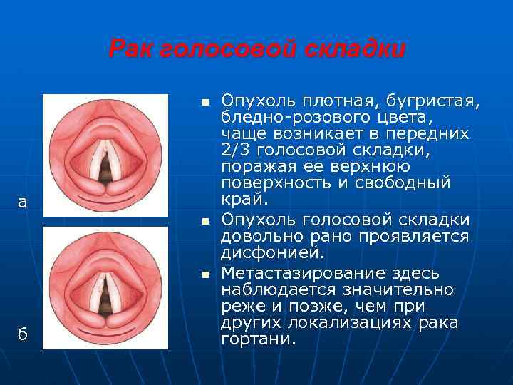 Рак голосовой складки n а n n б Опухоль плотная, бугристая, бледно-розового цвета, чаще