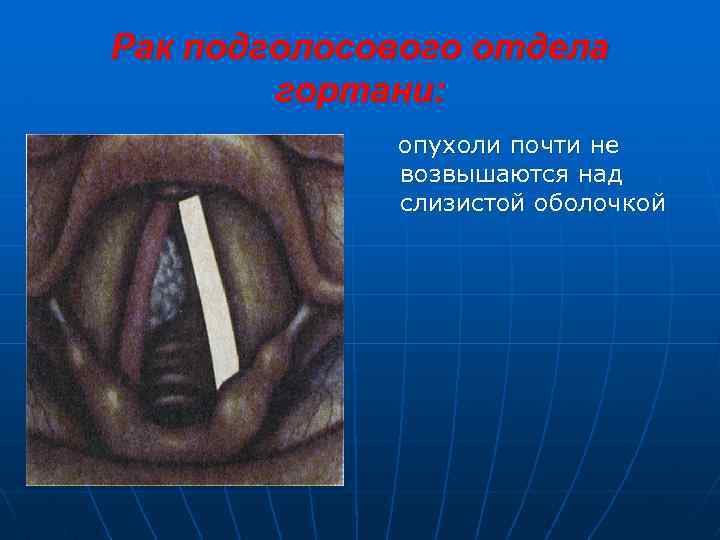 Рак подголосового отдела гортани: опухоли почти не возвышаются над слизистой оболочкой 