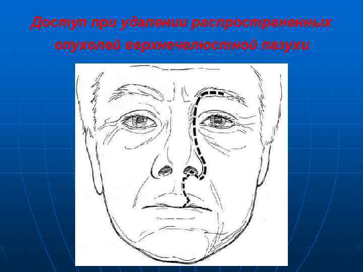 Доступ при удалении распространенных опухолей верхнечелюстной пазухи 