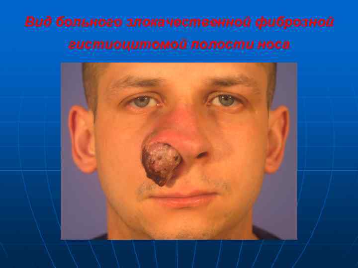 Вид больного злокачественной фиброзной гистиоцитомой полости носа 