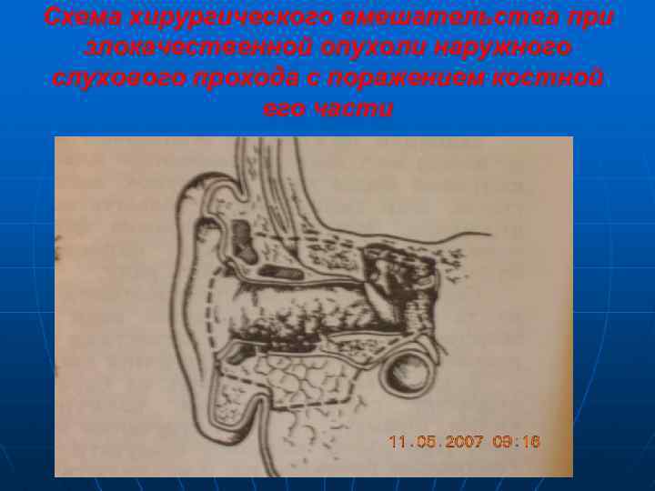 Схема хирургического вмешательства при злокачественной опухоли наружного слухового прохода с поражением костной его части