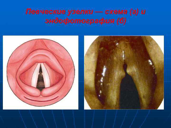 Певческие узелки — схема (а) и эндофотография (б) 
