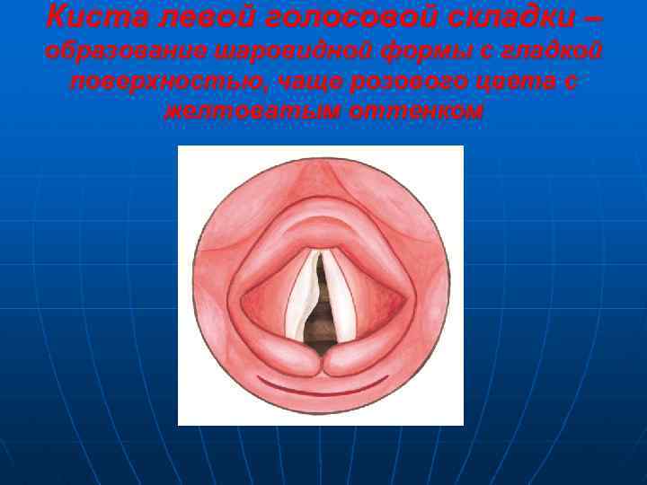 Киста левой голосовой складки – образование шаровидной формы с гладкой поверхностью, чаще розового цвета