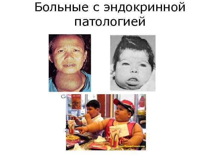 Больные с эндокринной патологией ЗОБ 