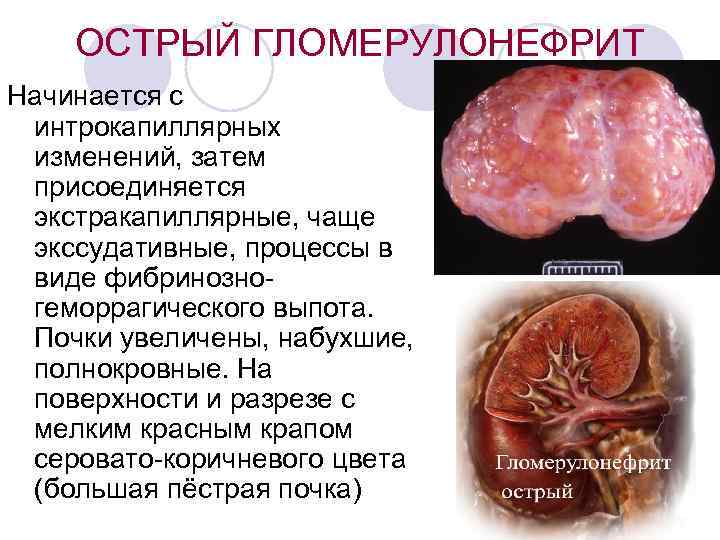 ОСТРЫЙ ГЛОМЕРУЛОНЕФРИТ Начинается с интрокапиллярных изменений, затем присоединяется экстракапиллярные, чаще экссудативные, процессы в виде