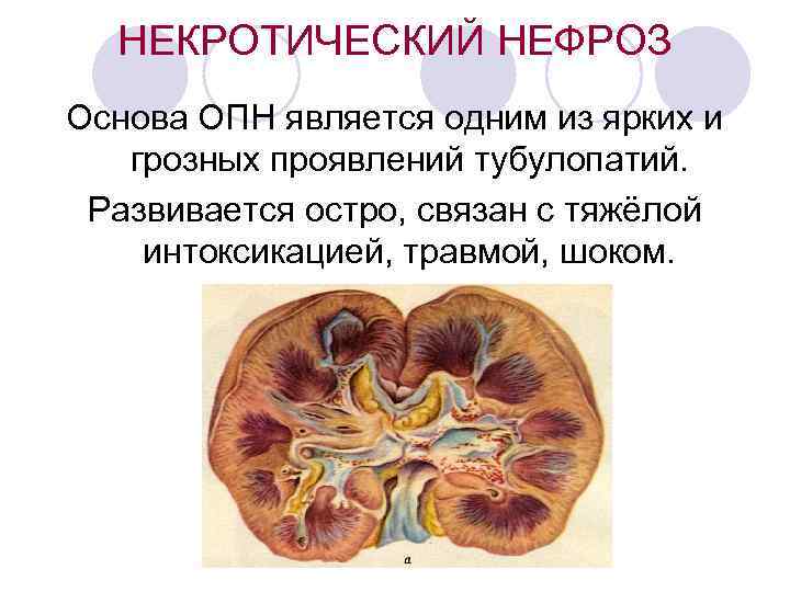 Нефроз. Некротический нефроз почка у животных. Острый некротический нефроз. Некротический нефроз патологическая анатомия. Гемоглобинурийный нефроз.