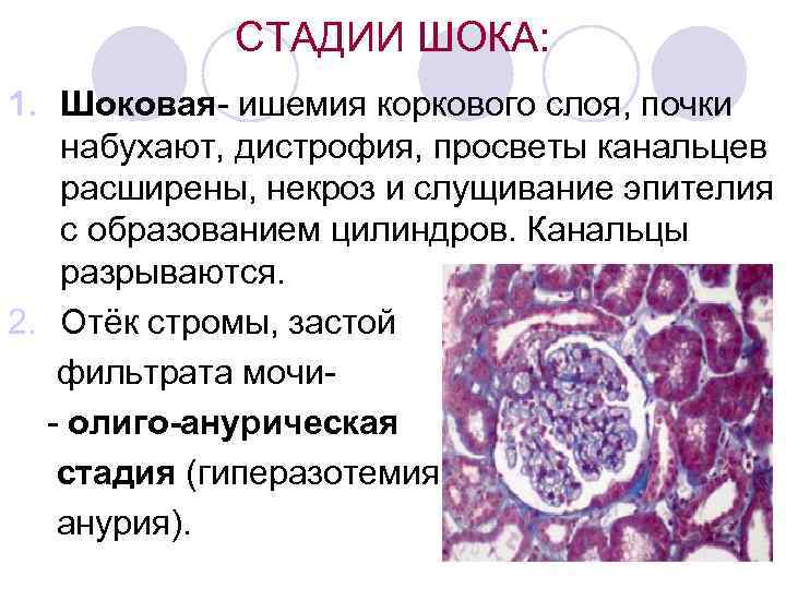 СТАДИИ ШОКА: 1. Шоковая- ишемия коркового слоя, почки набухают, дистрофия, просветы канальцев расширены, некроз