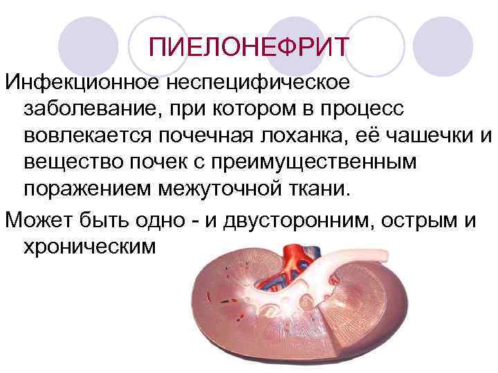 ПИЕЛОНЕФРИТ Инфекционное неспецифическое заболевание, при котором в процесс вовлекается почечная лоханка, её чашечки и