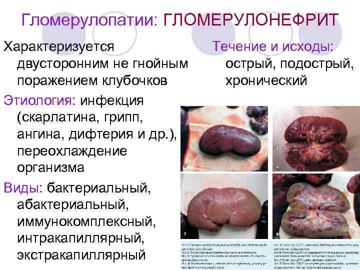 Гломерулопатии: ГЛОМЕРУЛОНЕФРИТ Характеризуется двусторонним не гнойным поражением клубочков Этиология: инфекция (скарлатина, грипп, ангина, дифтерия