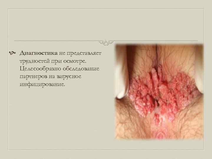  Диагностика не представляет трудностей при осмотре. Целесообразно обследование партнеров на вирусное инфицирование. 