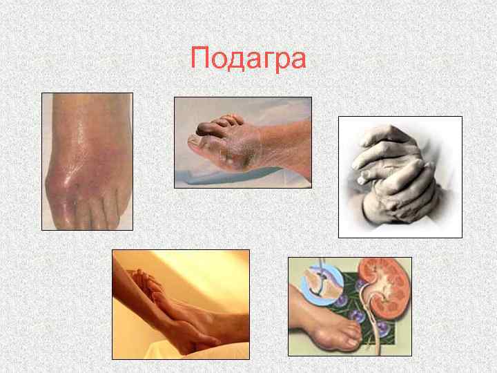 Подагра 